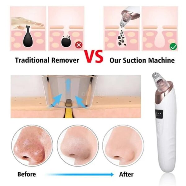 Blackhead Remover - Image 3